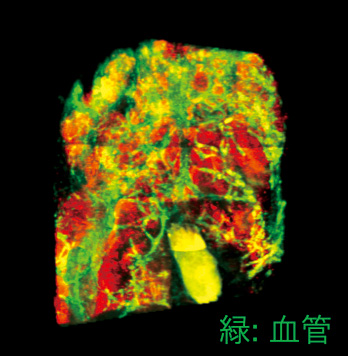 がん組織の染色画像。赤色ががん細胞、緑色が組織内の血管を表している。